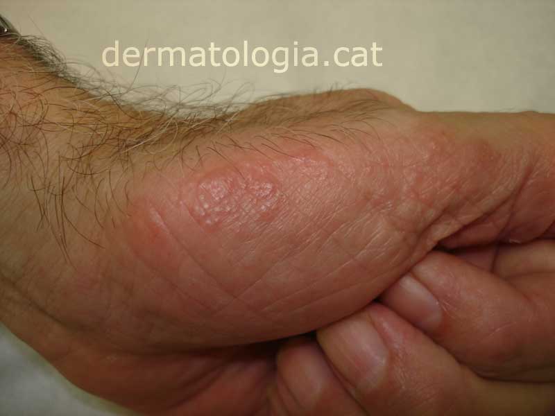 vörös foltok a lábakon vasculitis eczema or psoriasis on feet